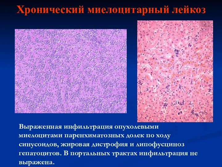 Хронический миелоцитарный лейкоз Выраженная инфильтрация опухолевыми миелоцитами паренхиматозных долек по ходу