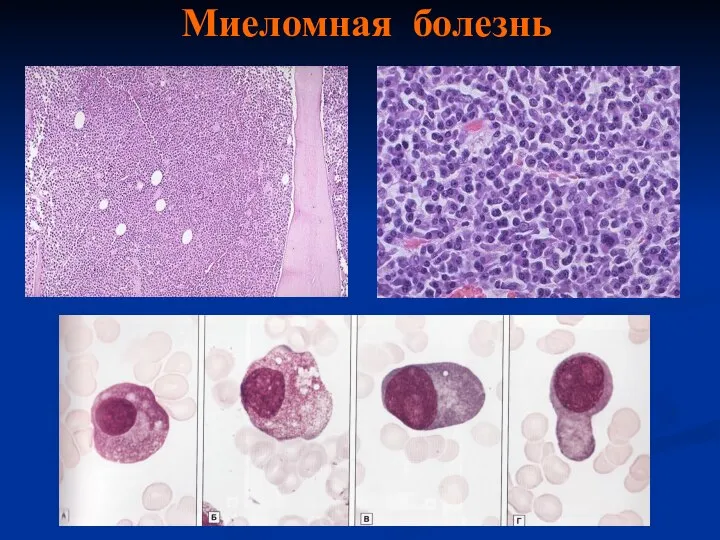 Миеломная болезнь