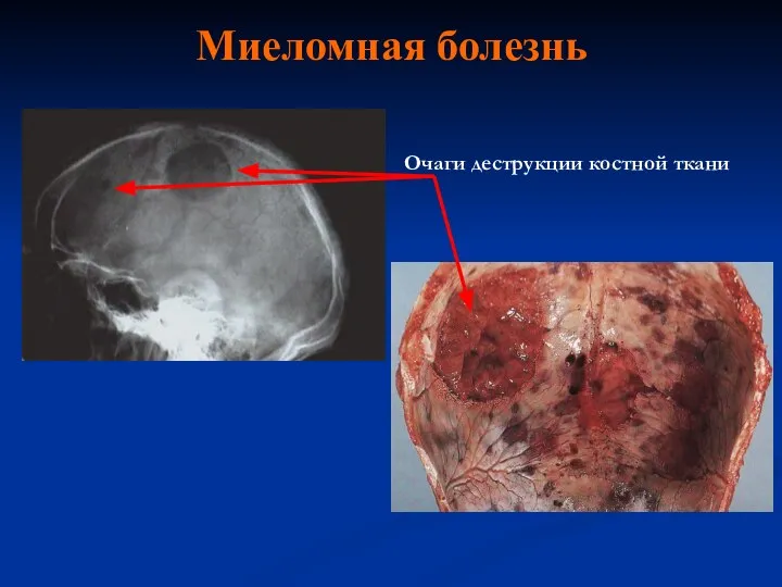 Миеломная болезнь Очаги деструкции костной ткани