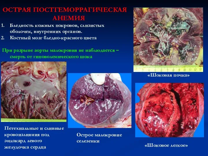 ОСТРАЯ ПОСТГЕМОРРАГИЧЕСКАЯ АНЕМИЯ Бледность кожных покровов, слизистых оболочек, внутренних органов. Костный