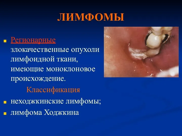 ЛИМФОМЫ Регионарные злокачественные опухоли лимфоидной ткани, имеющие моноклоновое происхождение. Классификация неходжкинские лимфомы; лимфома Ходжкина