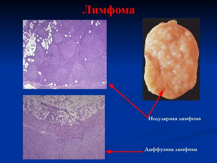 Лимфома Диффузная лимфома Нодулярная лимфома