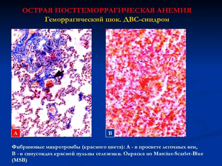 ОСТРАЯ ПОСТГЕМОРРАГИЧЕСКАЯ АНЕМИЯ Геморрагический шок. ДВС-синдром Фибриновые микротромбы (красного цвета): А