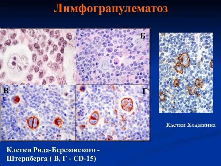 Лимфогранулематоз Клетки Рида-Березовского -Штернберга ( В, Г - СD-15) Клетки Ходжкина