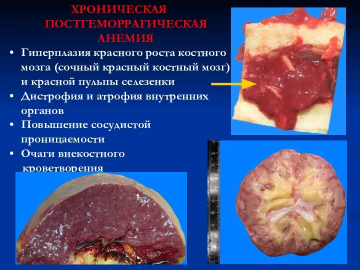 ХРОНИЧЕСКАЯ ПОСТГЕМОРРАГИЧЕСКАЯ АНЕМИЯ Гиперплазия красного роста костного мозга (сочный красный костный