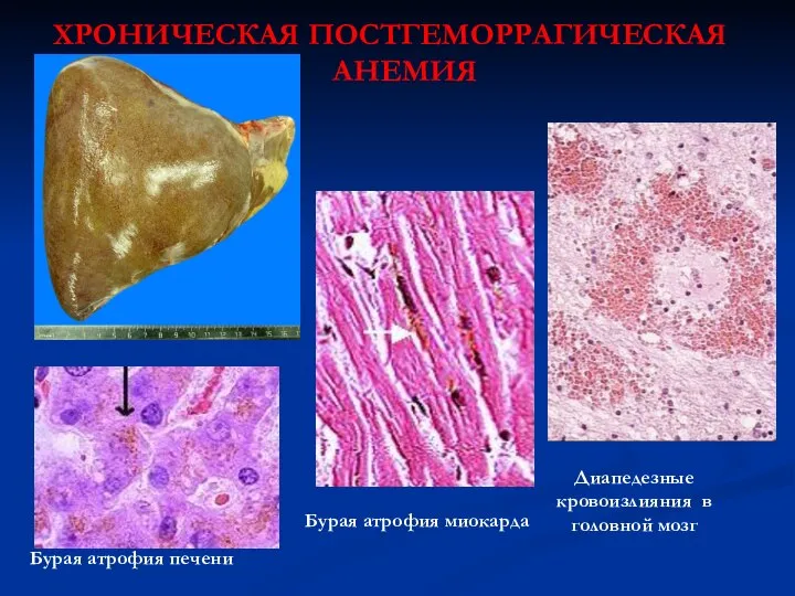 ХРОНИЧЕСКАЯ ПОСТГЕМОРРАГИЧЕСКАЯ АНЕМИЯ Бурая атрофия печени Бурая атрофия миокарда Диапедезные кровоизлияния в головной мозг