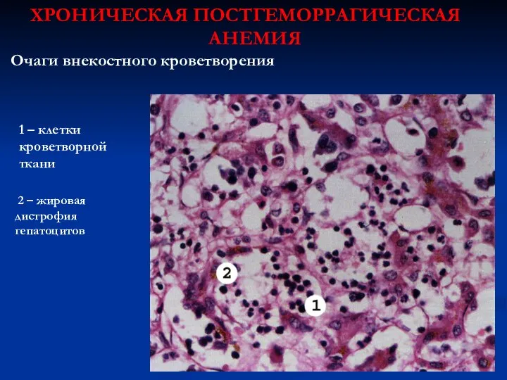 ХРОНИЧЕСКАЯ ПОСТГЕМОРРАГИЧЕСКАЯ АНЕМИЯ Очаги внекостного кроветворения 1 – клетки кроветворной ткани 2 – жировая дистрофия гепатоцитов