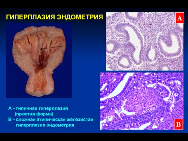 ГИПЕРПЛАЗИЯ ЭНДОМЕТРИЯ А В А - типичная гиперплазия (простая форма) В