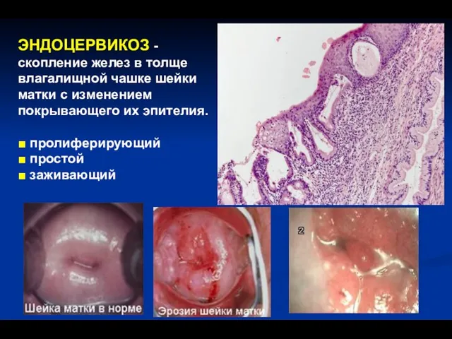 ЭНДОЦЕРВИКОЗ - скопление желез в толще влагалищной чашке шейки матки с