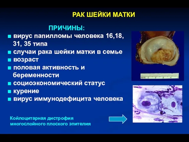 ПРИЧИНЫ: ■ вирус папилломы человека 16,18, 31, 35 типа ■ случаи