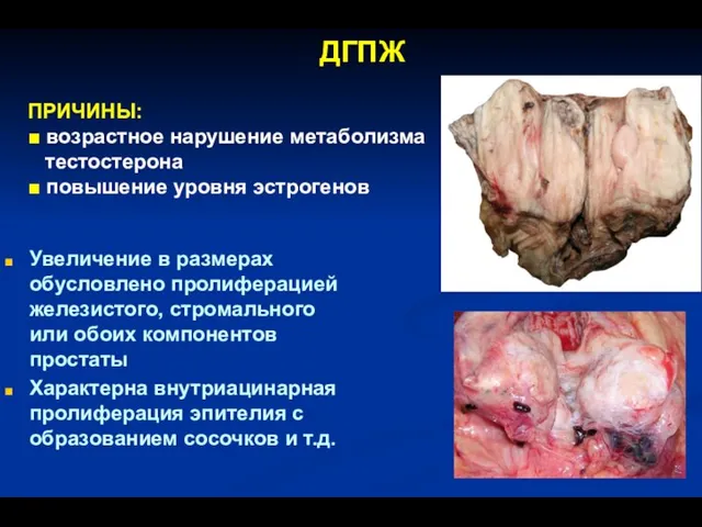ДГПЖ Увеличение в размерах обусловлено пролиферацией железистого, стромального или обоих компонентов