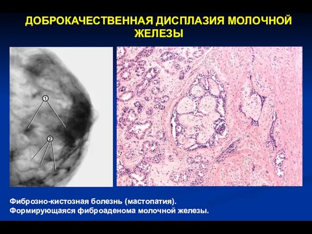 ДОБРОКАЧЕСТВЕННАЯ ДИСПЛАЗИЯ МОЛОЧНОЙ ЖЕЛЕЗЫ Фиброзно-кистозная болезнь (мастопатия). Формирующаяся фиброаденома молочной железы.