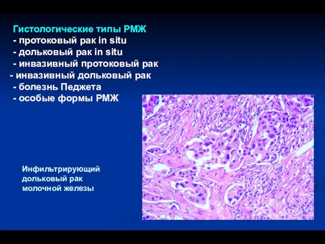 Гистологические типы РМЖ - протоковый рак in situ - дольковый рак