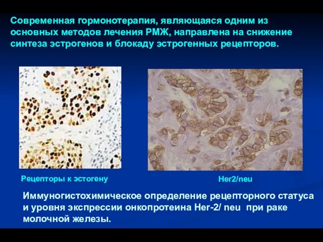 Современная гормонотерапия, являющаяся одним из основных методов лечения РМЖ, направлена на