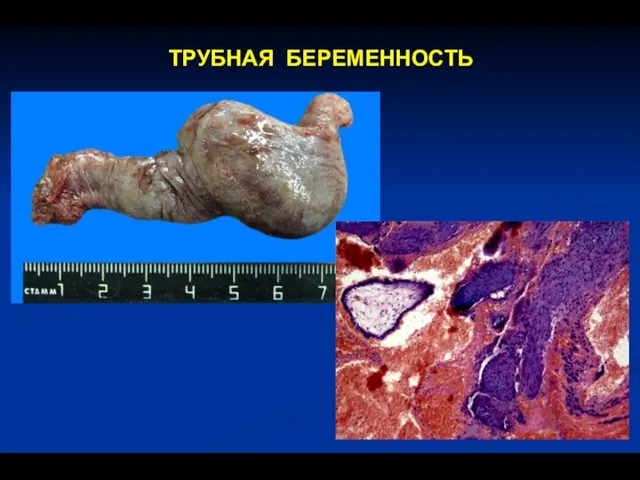 ТРУБНАЯ БЕРЕМЕННОСТЬ