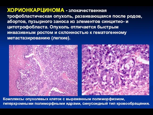 Комплексы опухолевых клеток с выраженным полиморфизмом, гиперхромными полиморфными ядрами, синусоидный тип