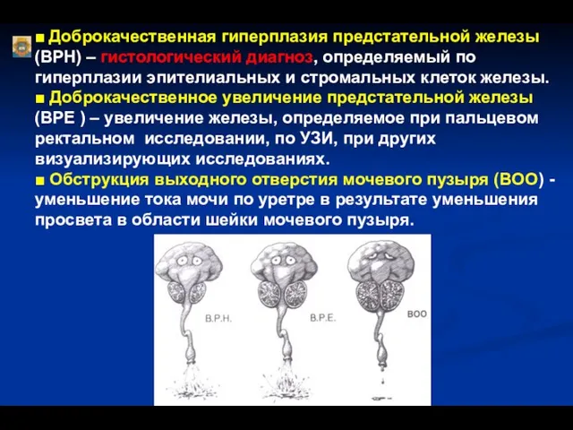 ■ Доброкачественная гиперплазия предстательной железы (BPH) – гистологический диагноз, определяемый по