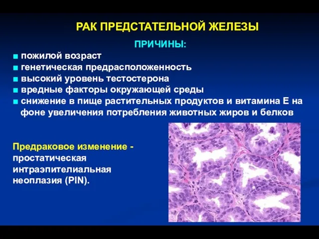 РАК ПРЕДСТАТЕЛЬНОЙ ЖЕЛЕЗЫ Предраковое изменение - простатическая интраэпителиальная неоплазия (PIN). ПРИЧИНЫ: