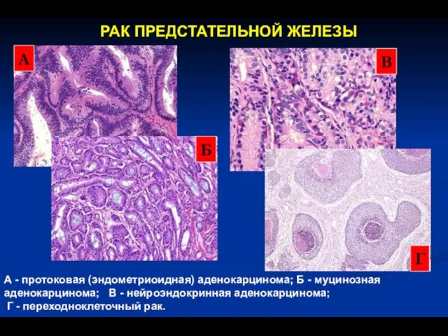 РАК ПРЕДСТАТЕЛЬНОЙ ЖЕЛЕЗЫ А - протоковая (эндометриоидная) аденокарцинома; Б - муцинозная