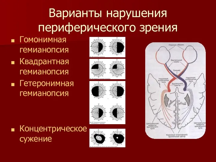 Варианты нарушения периферического зрения Гомонимная гемианопсия Квадрантная гемианопсия Гетеронимная гемианопсия Концентрическое сужение