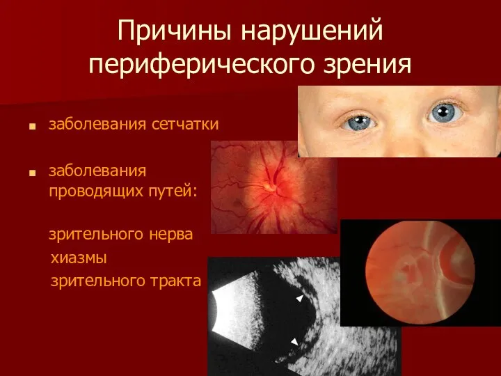 Причины нарушений периферического зрения заболевания сетчатки заболевания проводящих путей: зрительного нерва хиазмы зрительного тракта