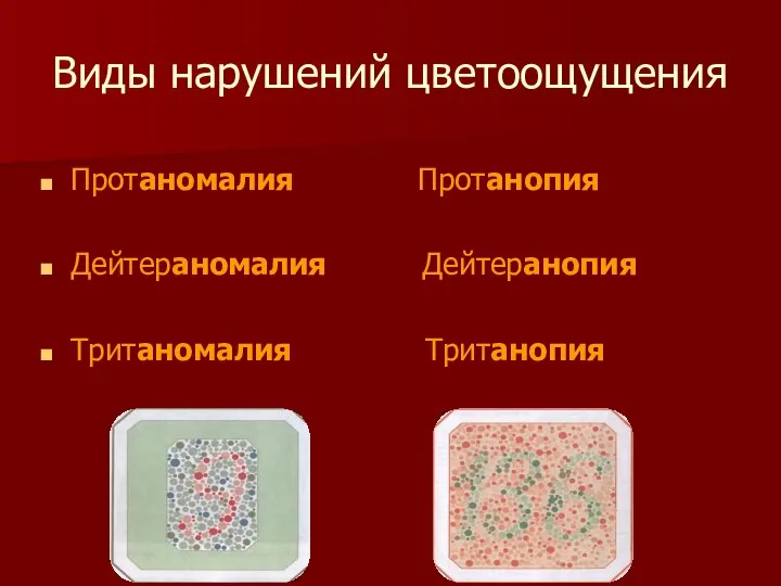 Виды нарушений цветоощущения Протаномалия Протанопия Дейтераномалия Дейтеранопия Тританомалия Тританопия