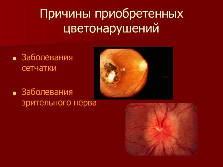 Причины приобретенных цветонарушений Заболевания сетчатки Заболевания зрительного нерва