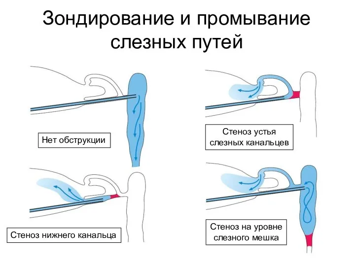 Зондирование и промывание слезных путей Нет обструкции Стеноз нижнего канальца Стеноз