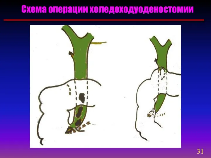 Схема операции холедоходуоденостомии