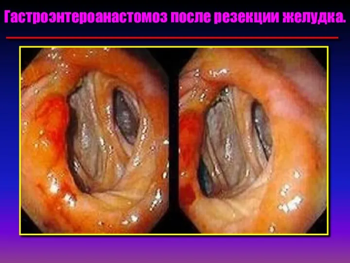 Гастроэнтероанастомоз после резекции желудка.