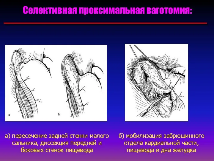 Селективная проксимальная ваготомия: а) пересечение задней стенки малого сальника, диссекция передней
