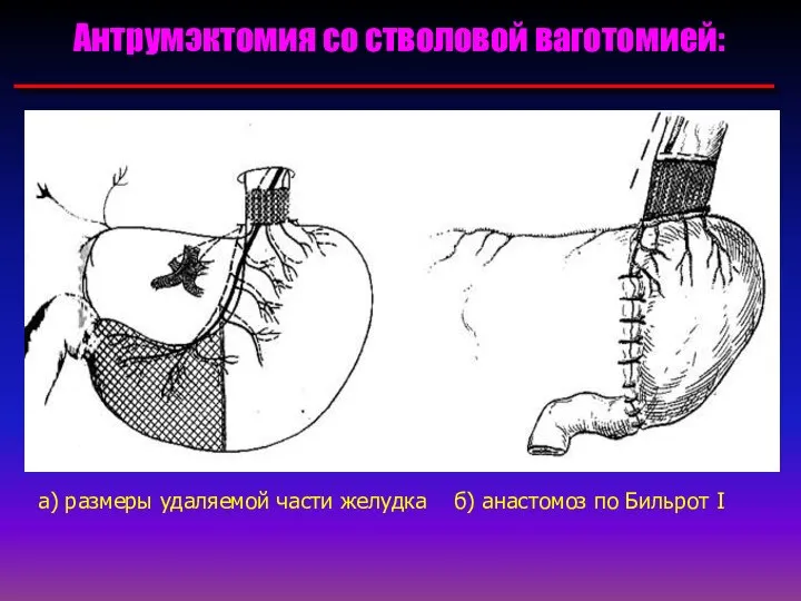 Антрумэктомия со стволовой ваготомией: а) размеры удаляемой части желудка б) анастомоз по Бильрот I