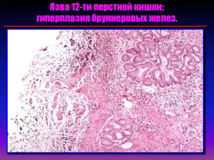 Язва 12-ти перстной кишки: гиперплазия бруннеровых желез.