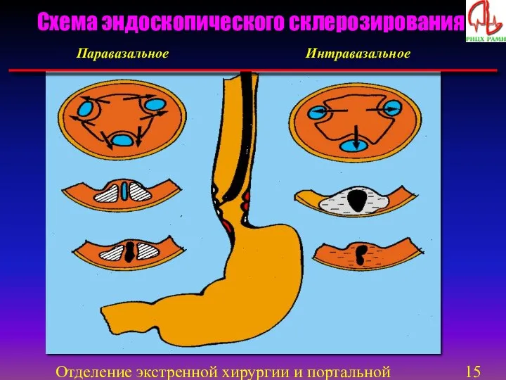 Отделение экстренной хирургии и портальной гипертензии Паравазальное Интравазальное Схема эндоскопического склерозирования