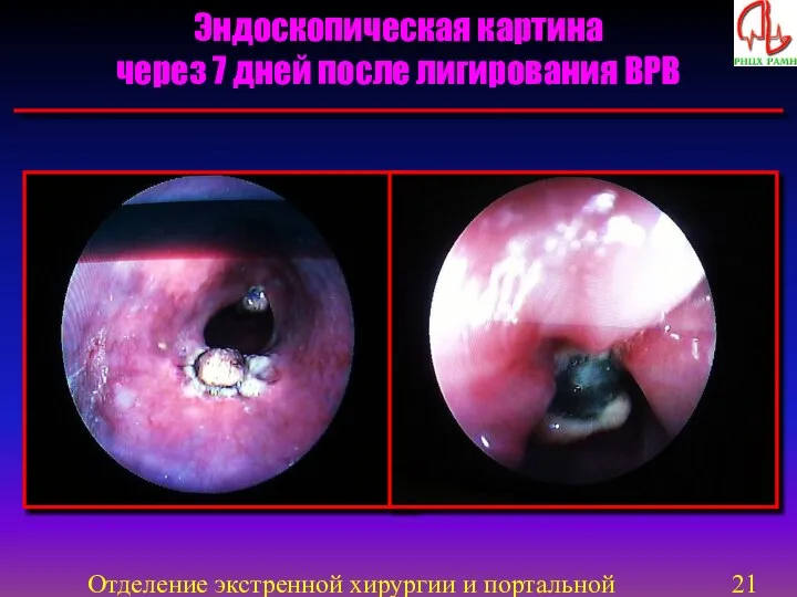 Отделение экстренной хирургии и портальной гипертензии Эндоскопическая картина через 7 дней после лигирования ВРВ