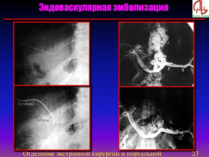 Отделение экстренной хирургии и портальной гипертензии Эндоваскулярная эмболизация