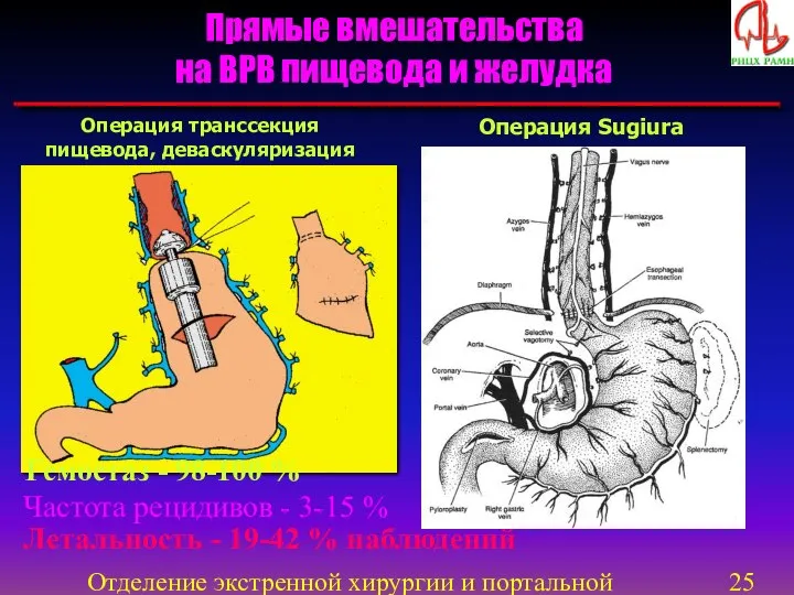 Отделение экстренной хирургии и портальной гипертензии Прямые вмешательства на ВРВ пищевода