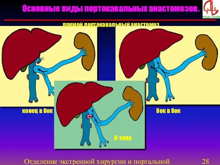 Отделение экстренной хирургии и портальной гипертензии Основные виды портокавальных анастомозов. прямой