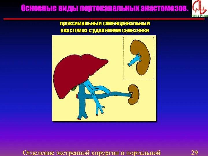 Отделение экстренной хирургии и портальной гипертензии проксимальный спленоренальный анастомоз с удалением селезенки Основные виды портокавальных анастомозов.