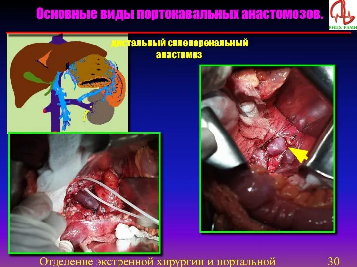 Отделение экстренной хирургии и портальной гипертензии Основные виды портокавальных анастомозов. дистальный спленоренальный анастомоз