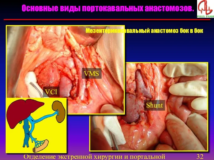 Отделение экстренной хирургии и портальной гипертензии VMS VCI Shunt Основные виды