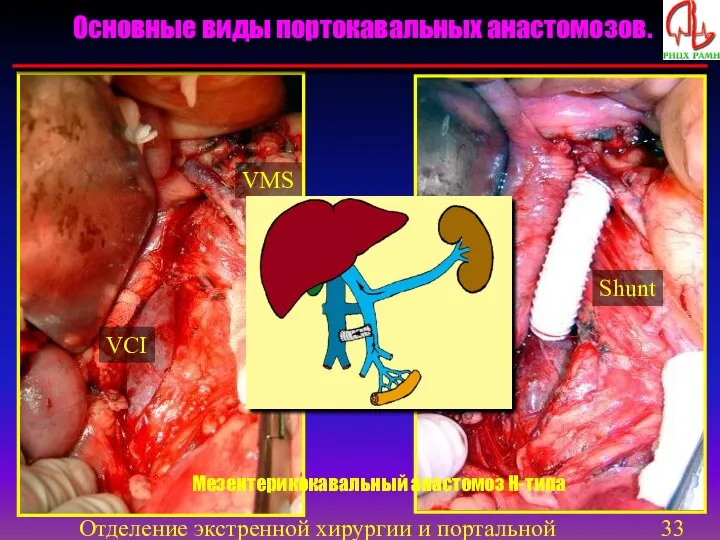 Отделение экстренной хирургии и портальной гипертензии VMS VCI Shunt Мезентерикокавальный анастомоз Н-типа Основные виды портокавальных анастомозов.