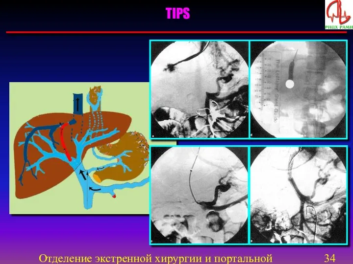 Отделение экстренной хирургии и портальной гипертензии TIPS