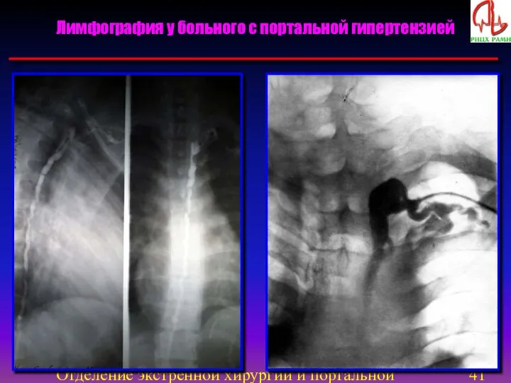 Отделение экстренной хирургии и портальной гипертензии Лимфография у больного с портальной гипертензией