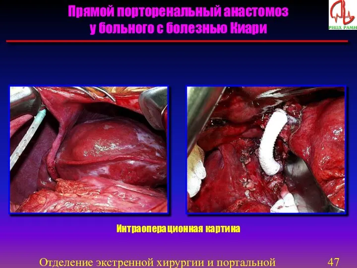 Отделение экстренной хирургии и портальной гипертензии Интраоперационная картина Прямой порторенальный анастомоз у больного с болезнью Киари