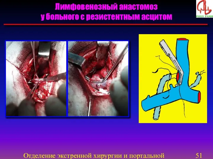Отделение экстренной хирургии и портальной гипертензии Лимфовенозный анастомоз у больного с резистентным асцитом