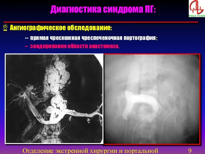 Отделение экстренной хирургии и портальной гипертензии Диагностика синдрома ПГ: Ангиографическое обследование: