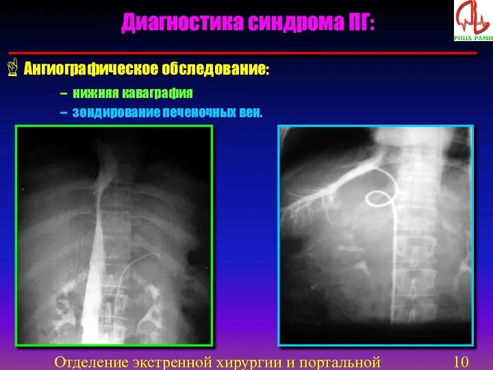 Отделение экстренной хирургии и портальной гипертензии Диагностика синдрома ПГ: Ангиографическое обследование: