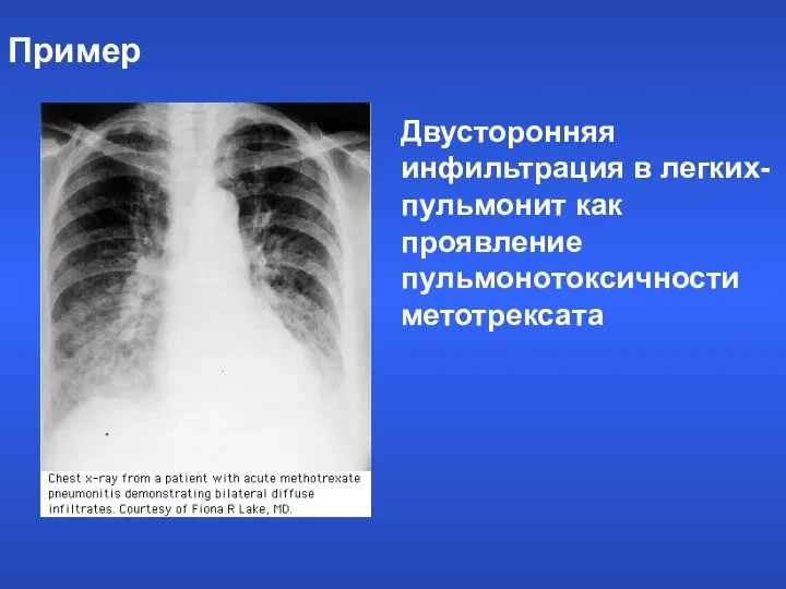 Пример Двусторонняя инфильтрация в легких- пульмонит как проявление пульмонотоксичности метотрексата