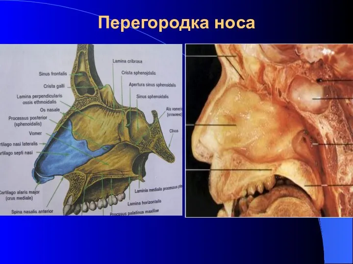 Перегородка носа 1.